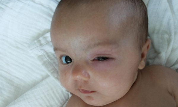 علائم عفونت نوزاد تازه متولد شده